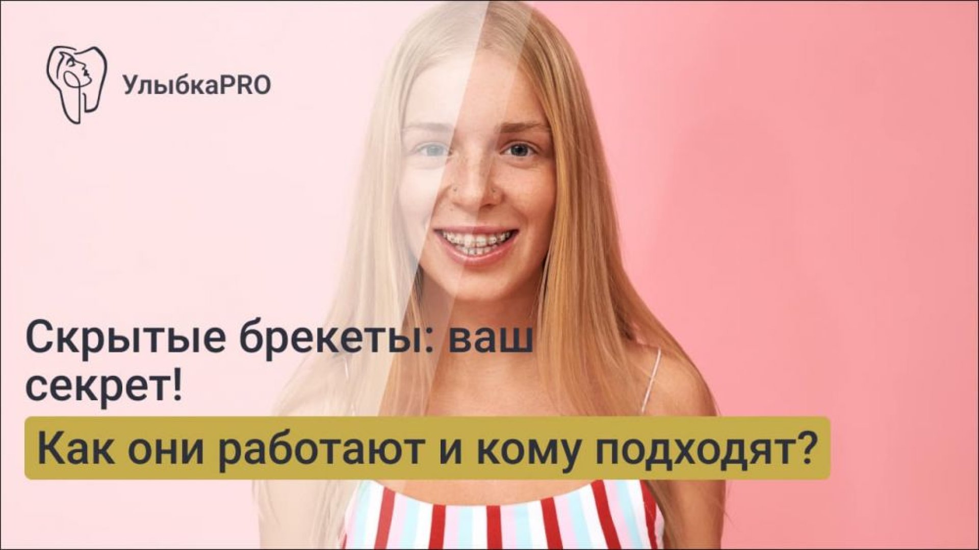 Скрытые брекеты как они работают и для кого они подходят
