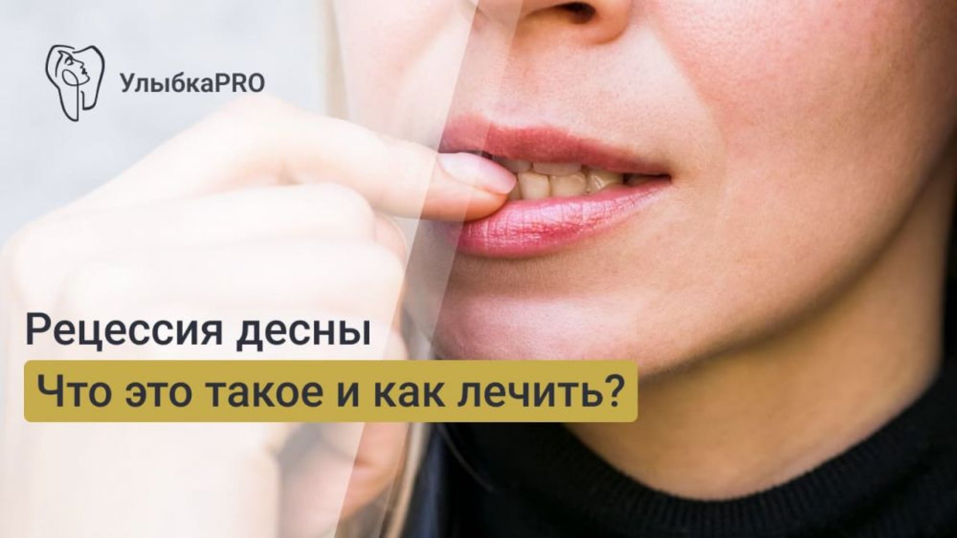 Что такое рецессия десны Простое объяснение