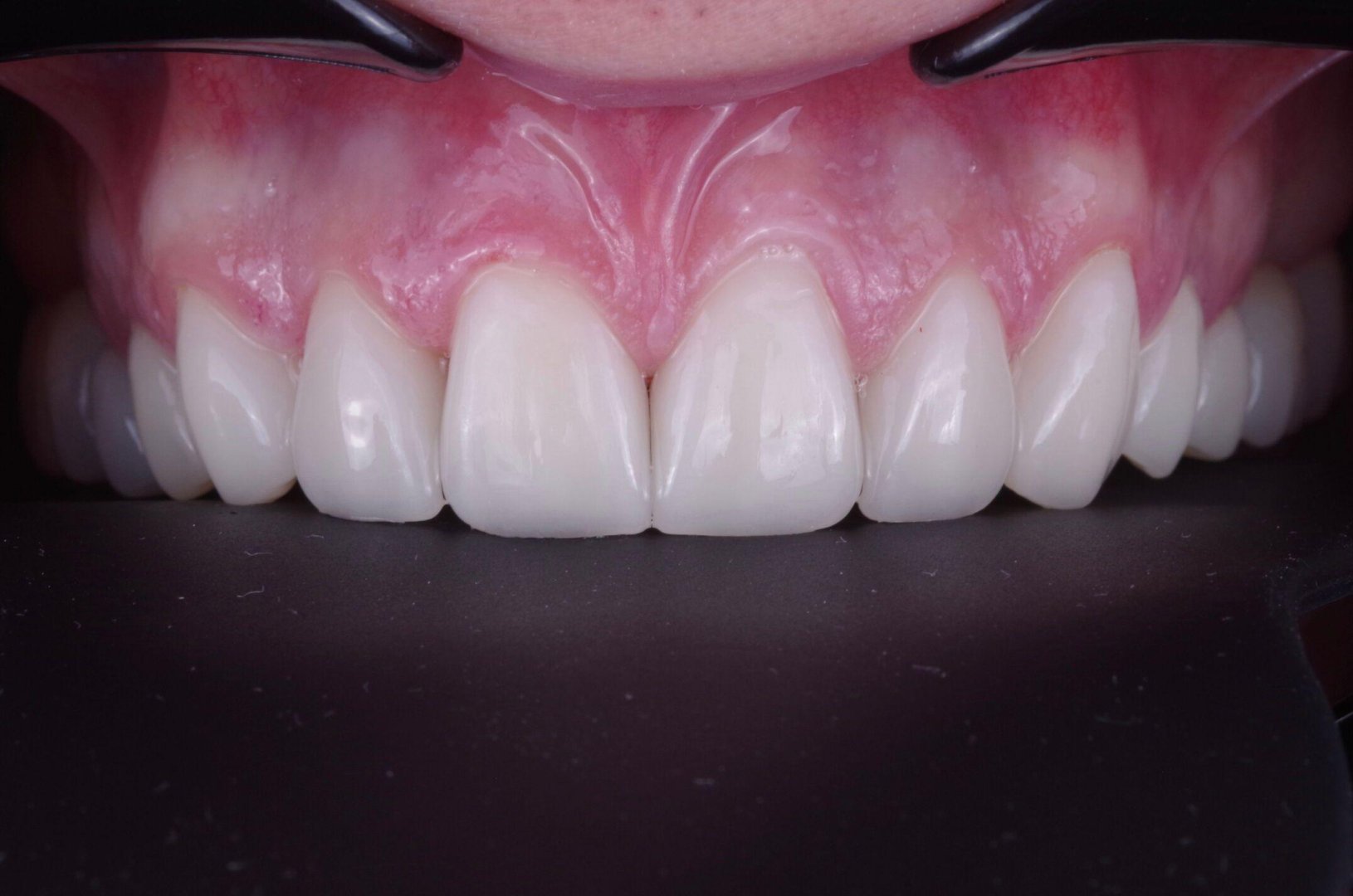 Виниры E.max — результат