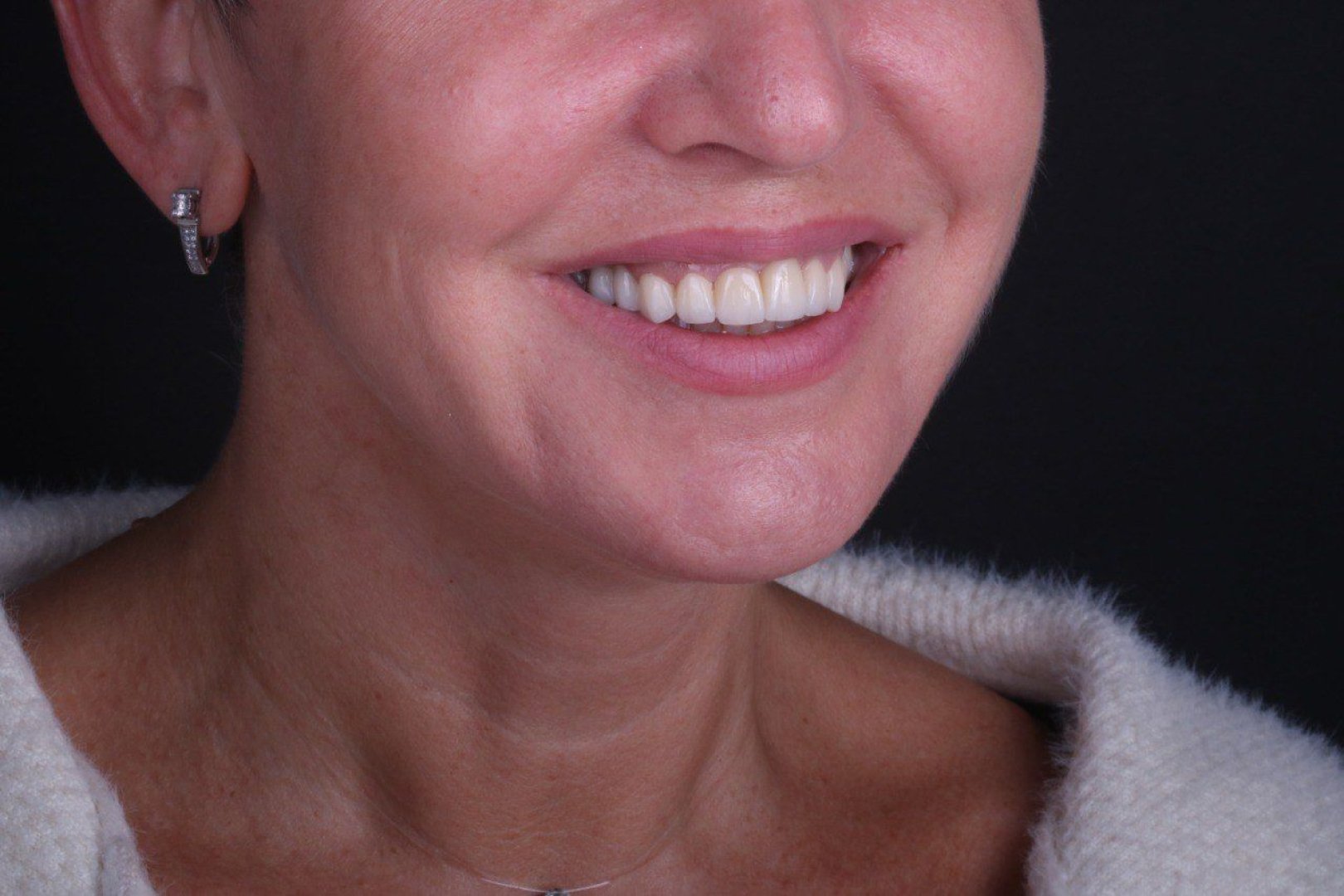 cirkonievie-koronki-foto-do-posle-1