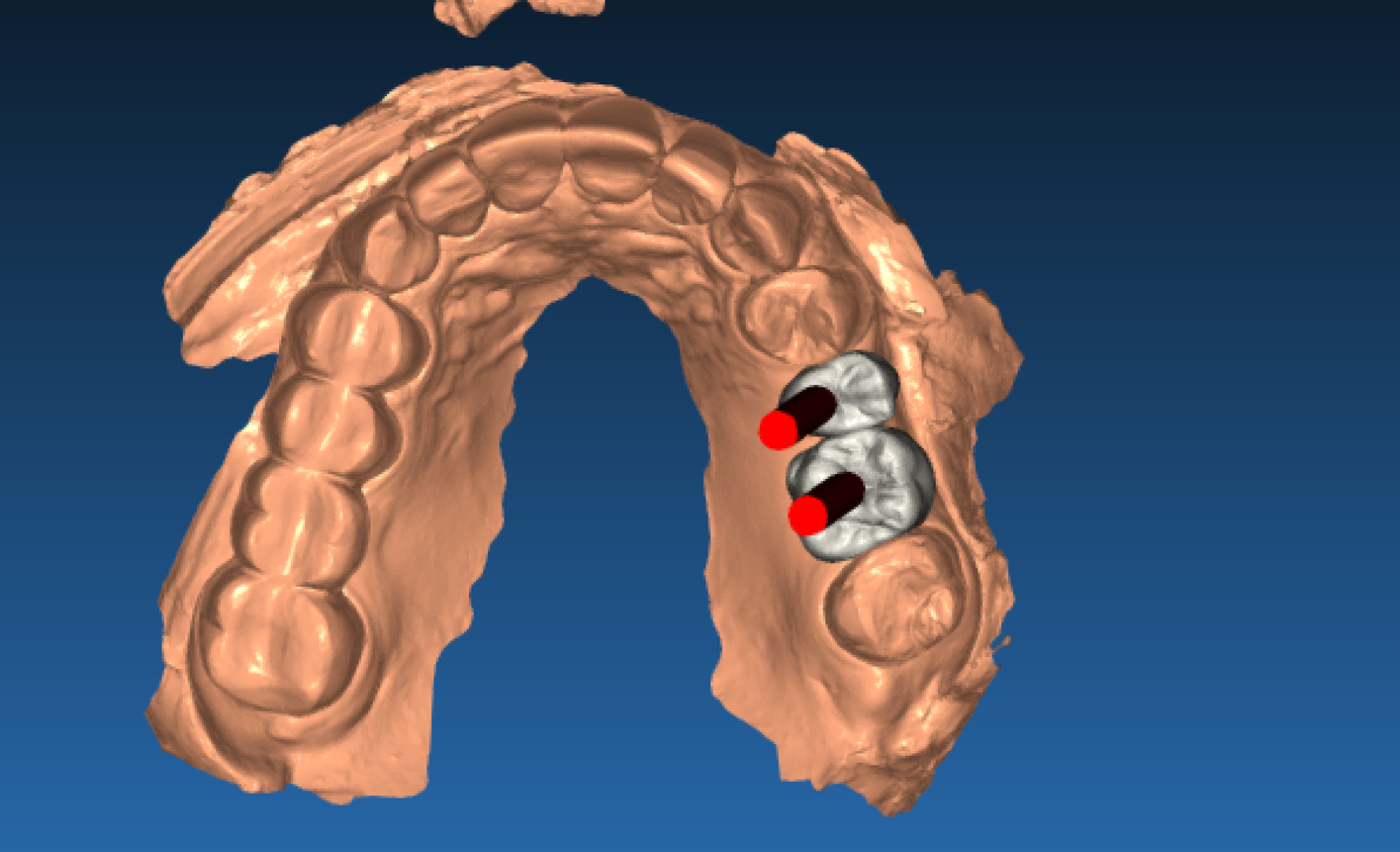 Хирургический шаблон для имплантации - вид 1