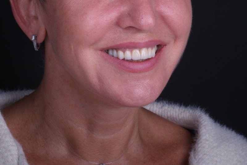 cirkonievie-koronki-foto-do-posle-1