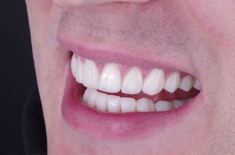 keramicheskie-viniri-foto-do-posle-8