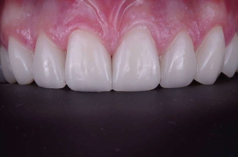 keramicheskie-viniri-foto-do-posle-10