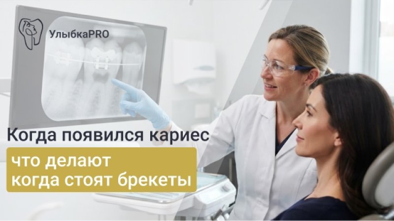 Лечение кариеса при брекетах: можно ли лечить зубы во время ортодонтического лечения