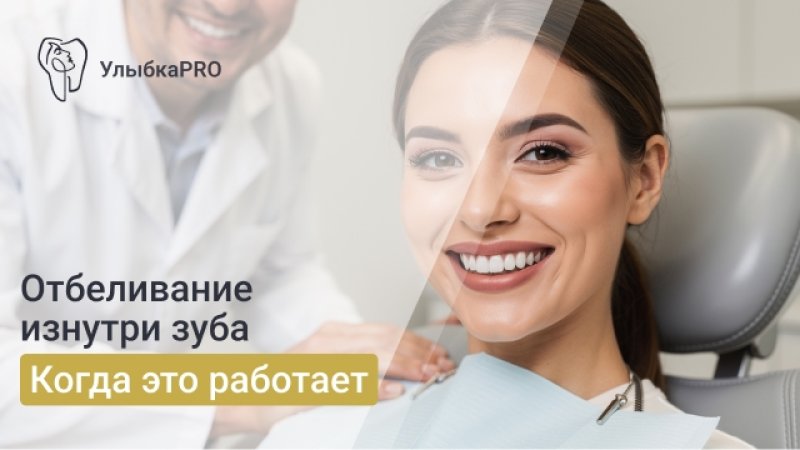 Эндоотбеливание зубов: как вернуть цвет потемневшему зубу изнутри
