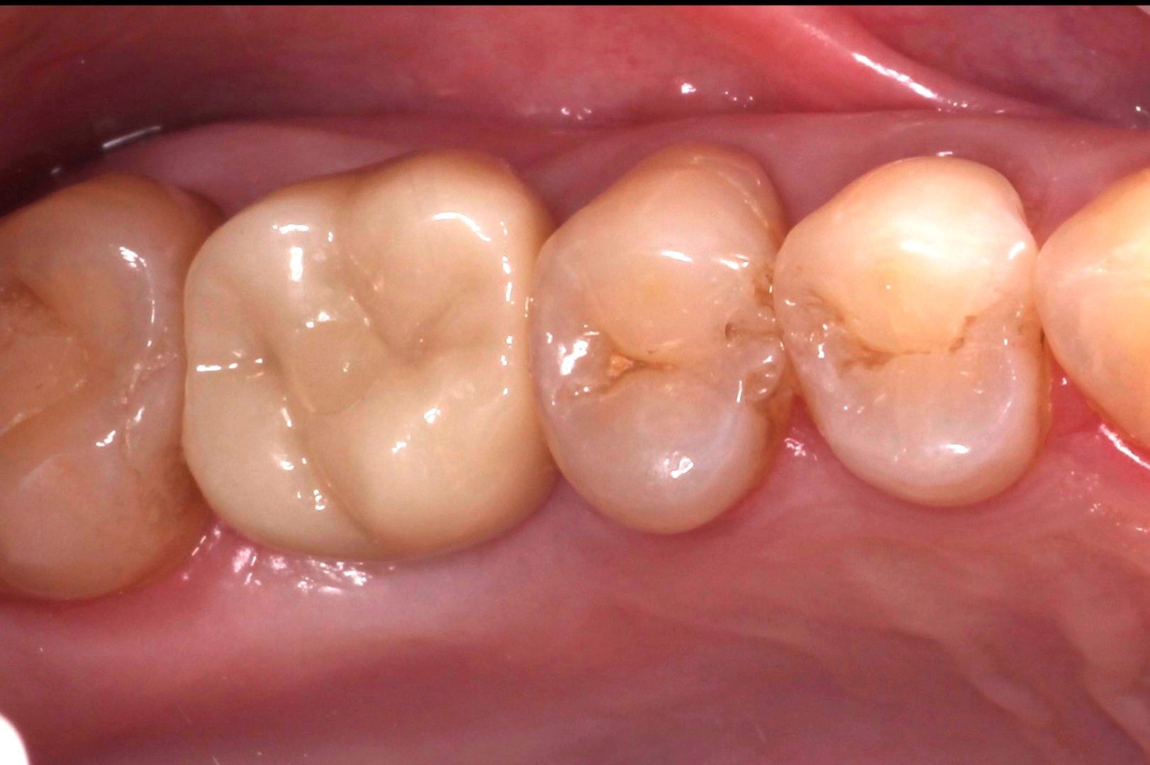 Циркониевая коронка на имплантате