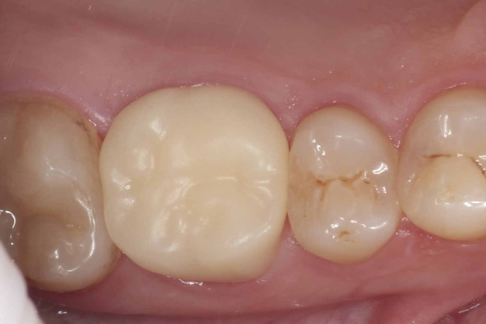 Временная коронка