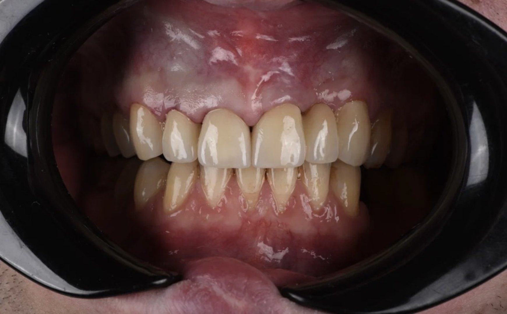 Протезирование и устранение рецессий