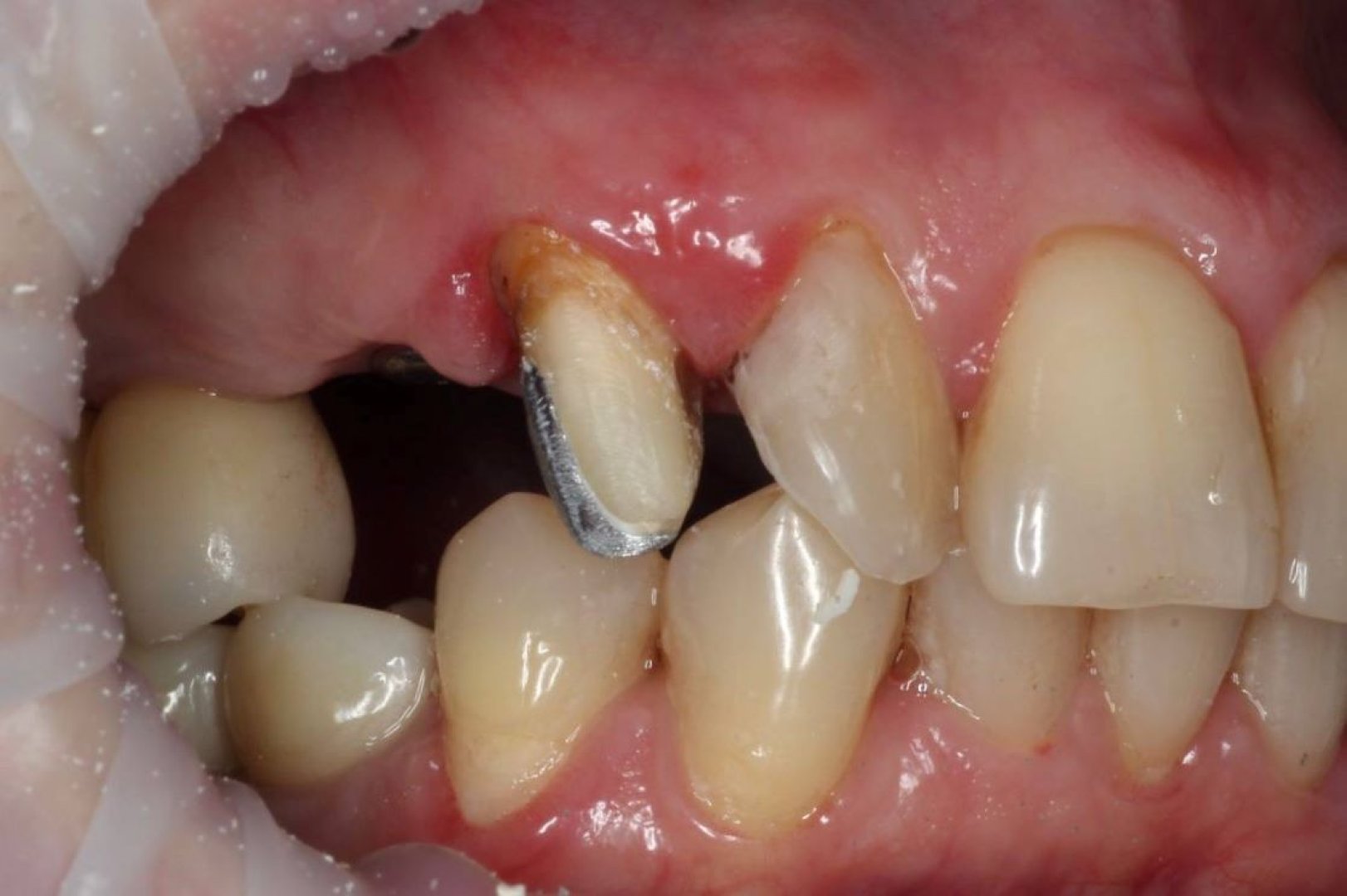 Перепротезирование зуба, имплантация_before
