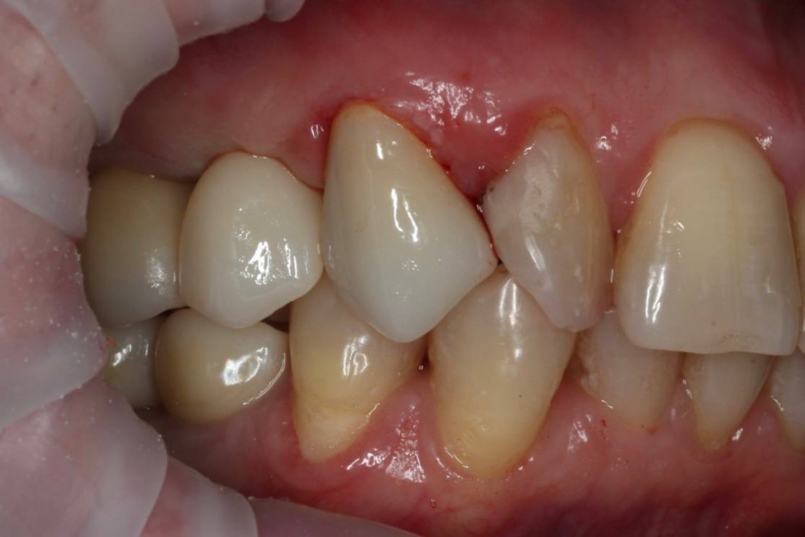 Перепротезирование зуба, имплантация