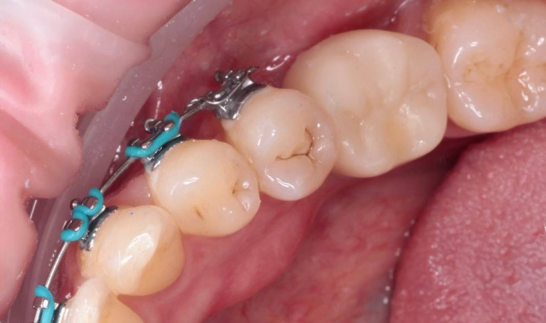 Временное протезирование PMMA коронкой