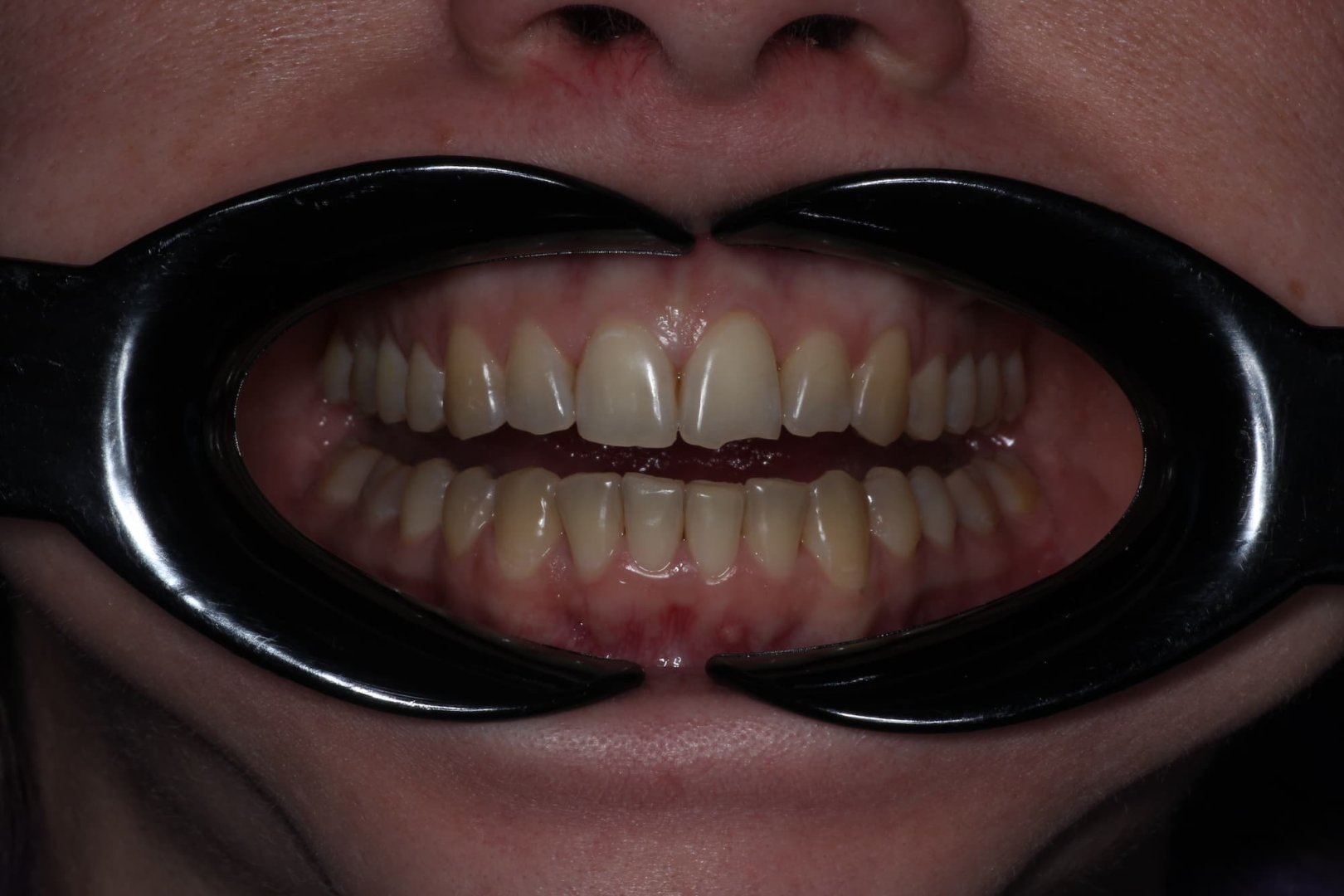 Лечение на элайнерах. Кейс 2