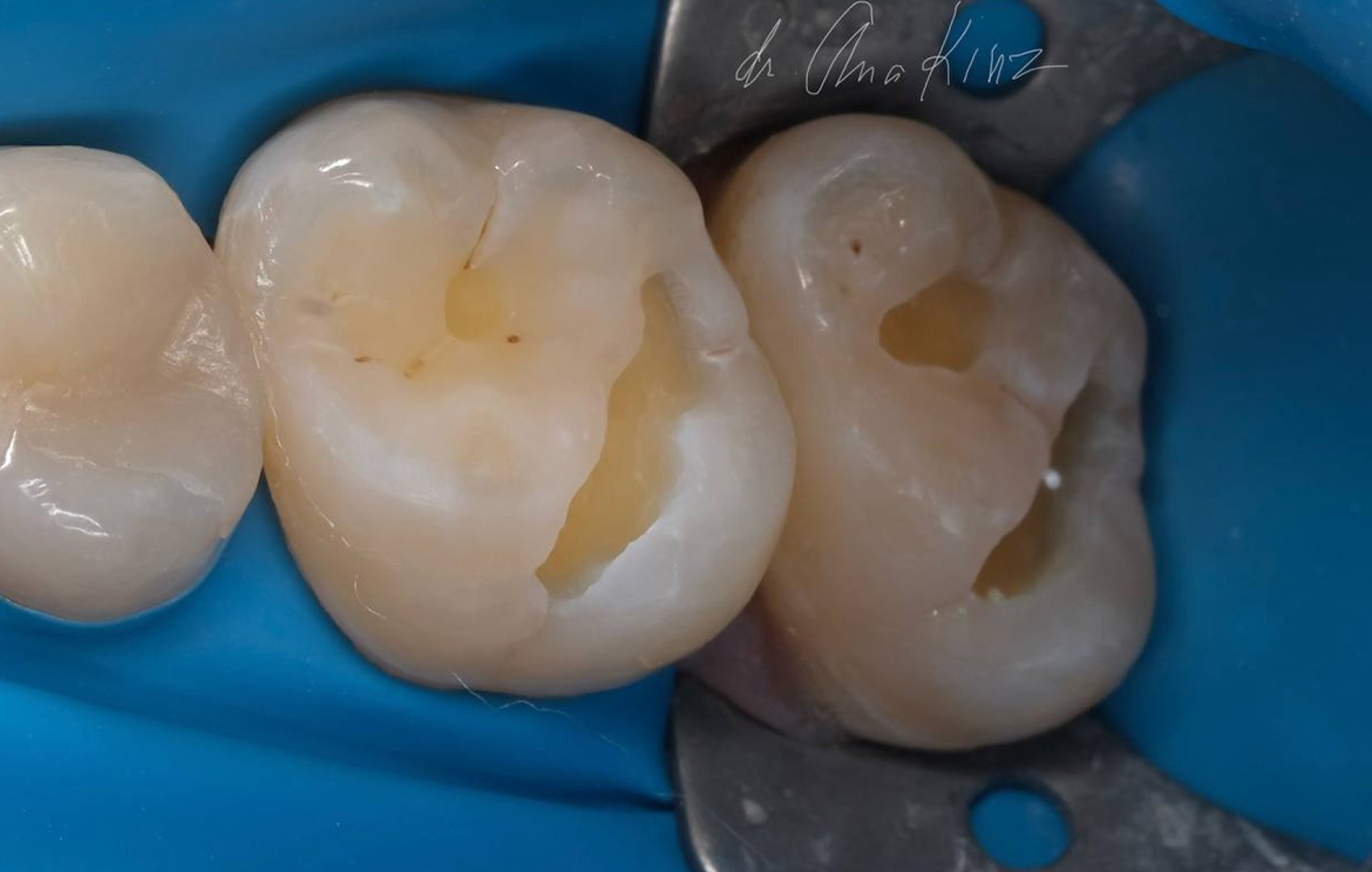 Комплексное восстановление жевательных зубов_before