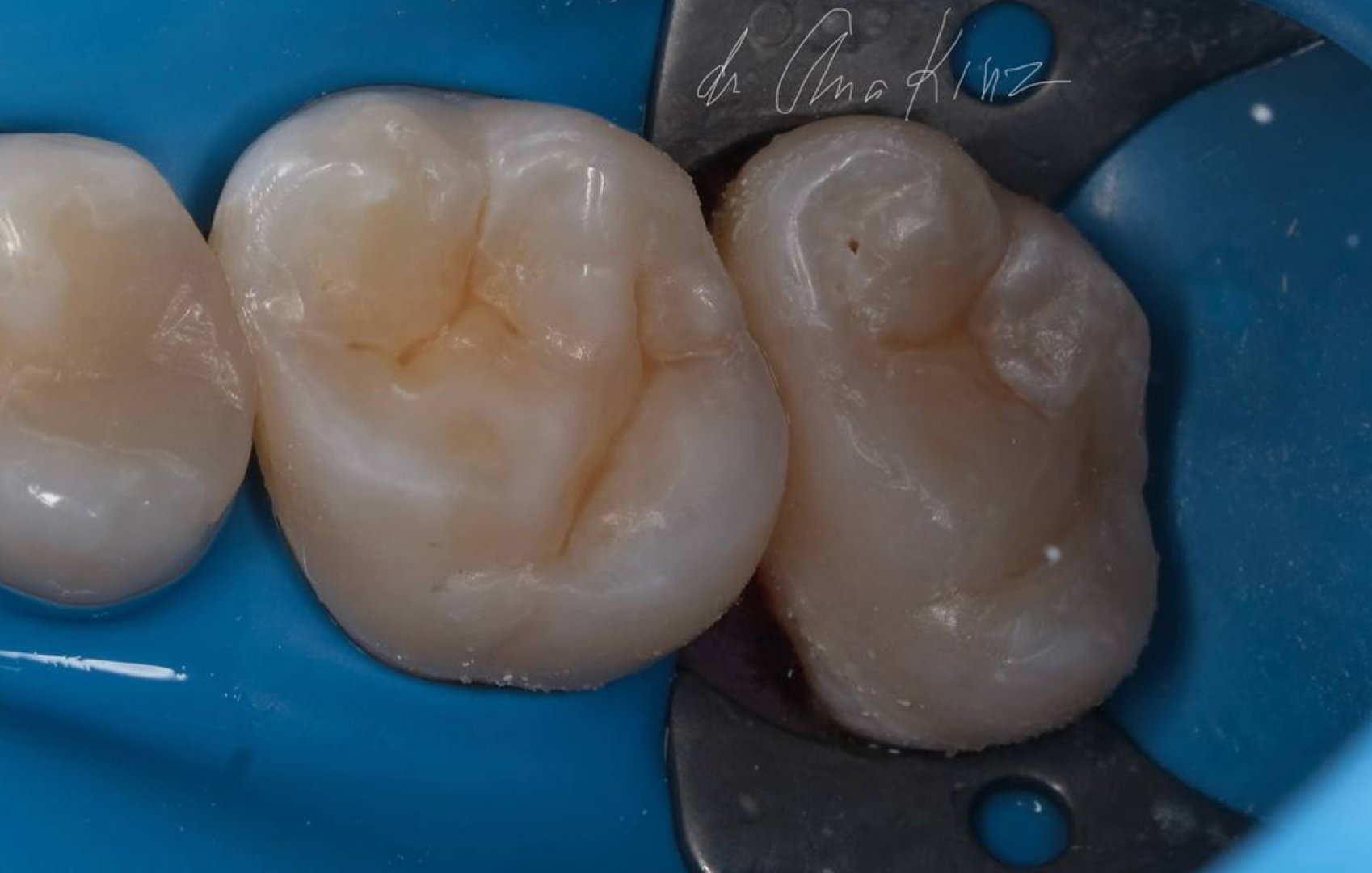 Комплексное восстановление жевательных зубов