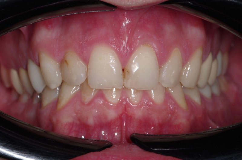 keramicheskie-viniri-foto-do-posle-1