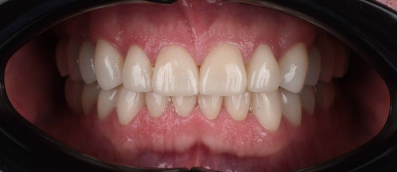 После: Тотальная реабилитация Фронт - виниры, жевательная группа зубов - коронки имакс